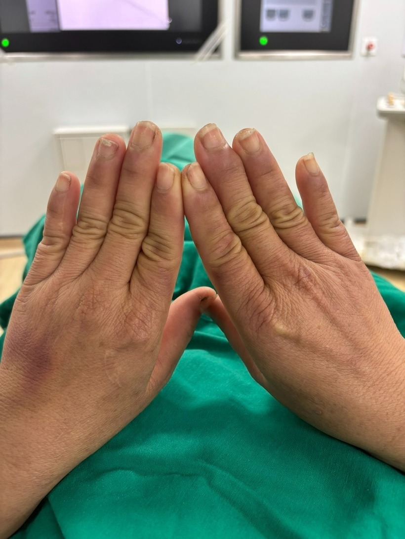 Mắc hội chứng "lạ" khiến người phụ nữ đau đớn mỗi khi chạm tay vào nước. Ảnh: BVCC.