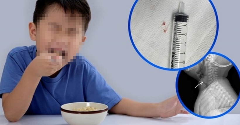 Ekip bác sĩ khoa Tai Mũi Họng nhanh chóng tiến hành nội soi và lấy ra hai mảnh xương cá mắc tại vị trí hạ thanh môn. Ảnh: Sức Khỏe & Đời Sống