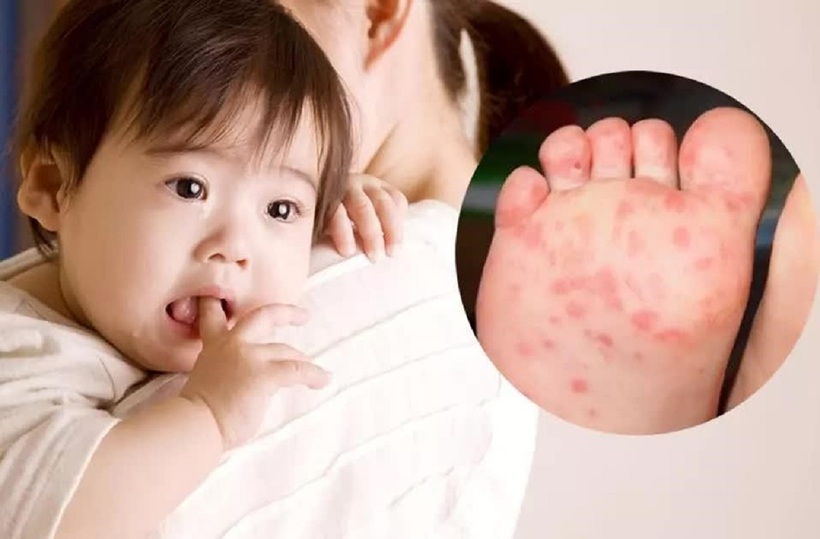 Bệnh tay chân miệng dễ dàng lây nhiễm qua tiếp xúc trực tiếp