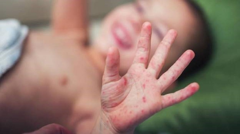 Trẻ bị tay chân miệng có thể tiềm ẩn một số biến chứng nguy hiểm