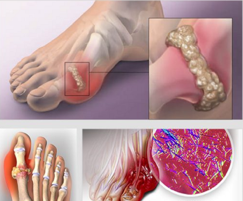 Kiểm soát axit uric máu cao ngăn ngừa bệnh gout