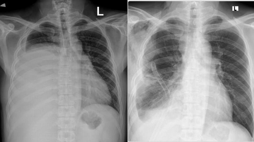 Hình ảnh phim chụp X.quang trước và sau khi phẫu thuật. Ảnh: Báo Xây dựng.