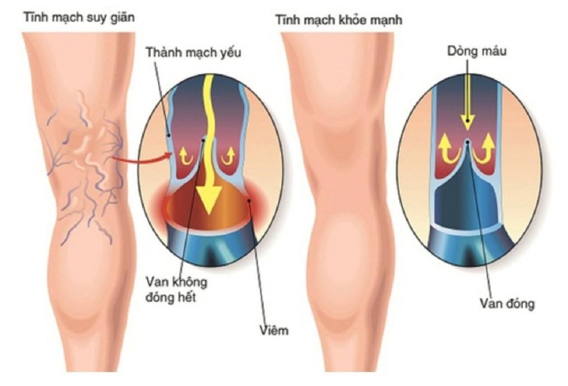 Trầm hương AGA chống đột quỵ – giảm cholesterol trong máu, giúp giảm nguy cơ xơ vữa động mạch, giúp tốt cho sức khoẻ tim mạch - 5