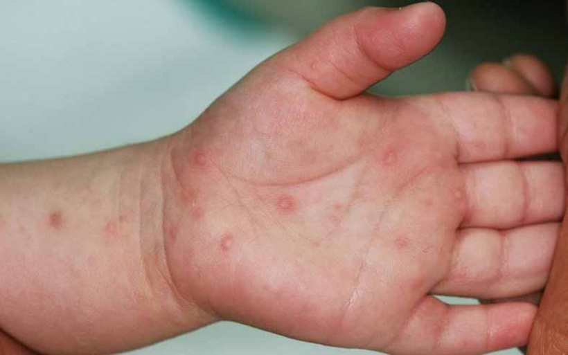 Dịch tay chân miệng gia tăng, dịch sởi chưa giảm nhiệt