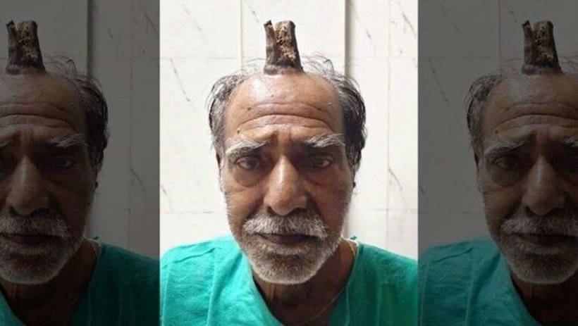 Chiếc sừng mọc trên đầu người đàn ông Ấn Độ. Ảnh: Fox News