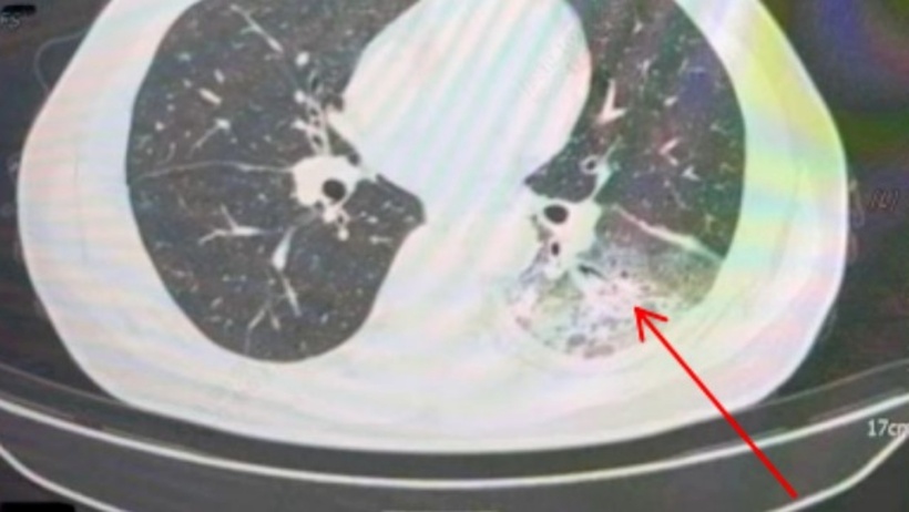 Các chuyên gia khuyến cáo người dân nên cảnh giác với bệnh viêm phổi Legionella.