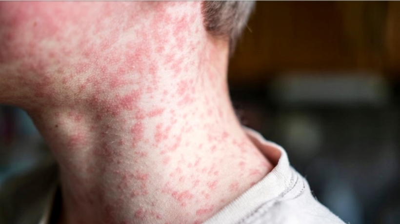 Tính đến ngày 8/5, Trung tâm Kiểm soát và phòng ngừa dịch bệnh (CDC) Mỹ đã báo cáo 1.001 ca mắc bệnh sởi tại 31 khu vực của nước này. Ảnh minh họa: Getty Images