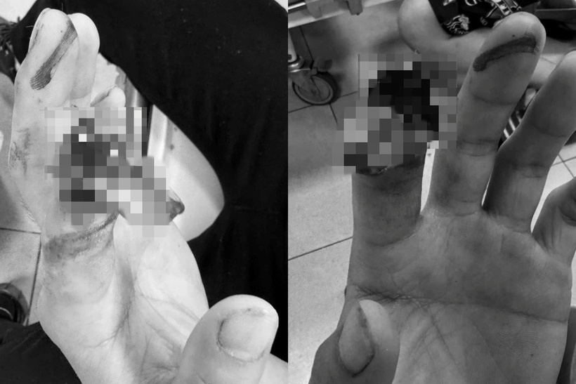Đeo găng tay bảo hộ quá rộng, nam công nhân gặp tai nạn kinh hoàng. Ảnh: Báo Dân trí.