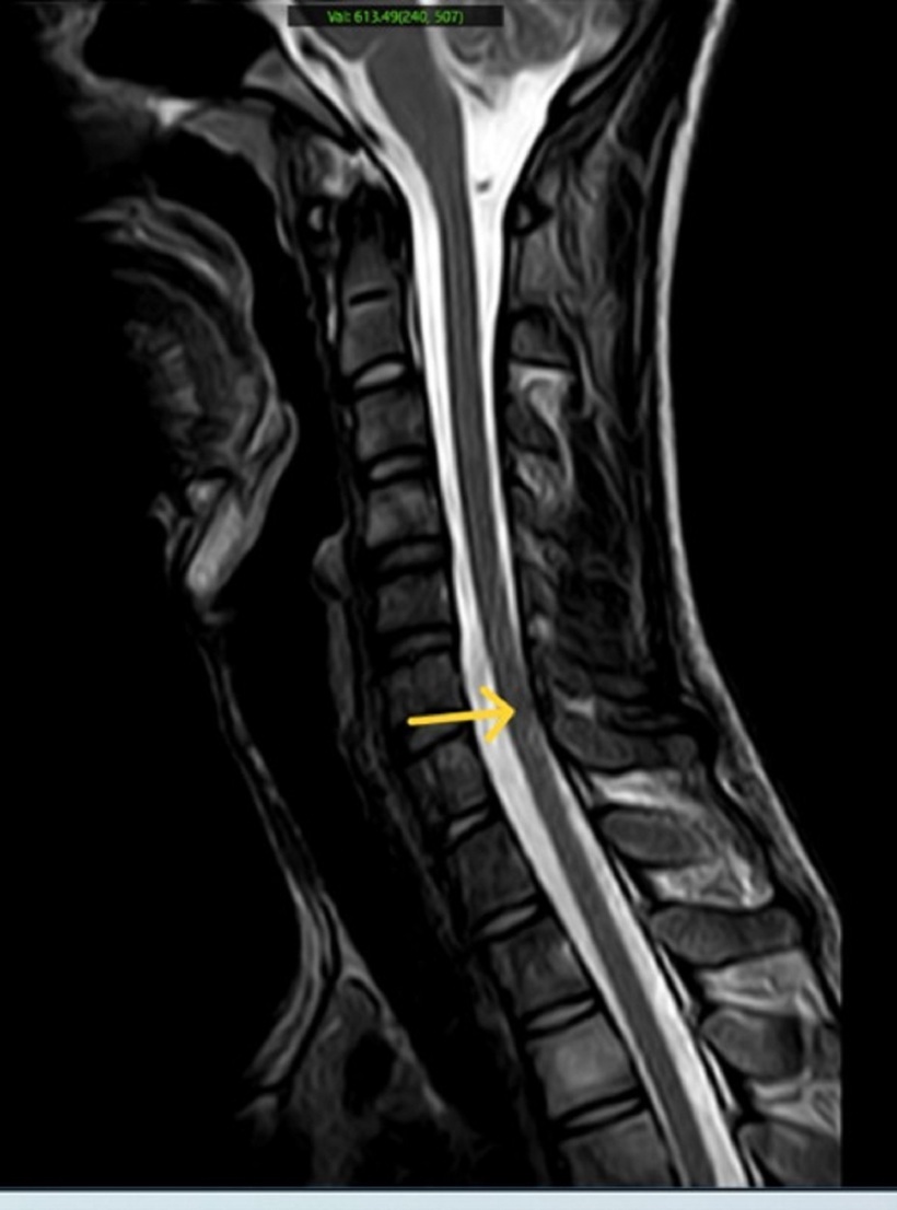 Hình ảnh MRI cột sống cổ có phù tủy xương thân đốt sống. Ảnh: Trung tâm Y học hạt nhân và Ung bướu