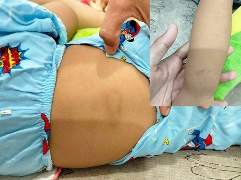 Cháu bé nghi bị bạo hành. Ảnh: Người lao động