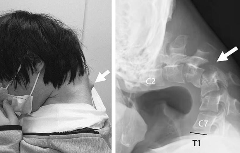 Hình ảnh chiếc cổ biến dạng, xiêu vẹo của nam thanh niên. Ảnh: JOS Case Reports