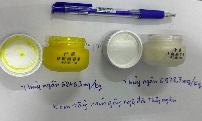 Bệnh nhân bị nhiễm độc sau một năm thoa kem trị nám có hàm lượng thủy ngân cao gấp vài nghìn lần ngưỡng cho phép. (Ảnh internet)