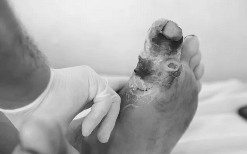 Biến chứng bàn chân ảnh hưởng nghiêm trọng đến cuộc sống của người bệnh đái tháo đường.