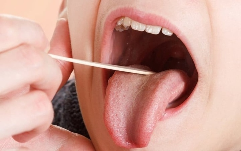 Loét miệng ba tháng không lành, đi khám phát hiện loại ung thư nguy hiểm. Ảnh minh họa.