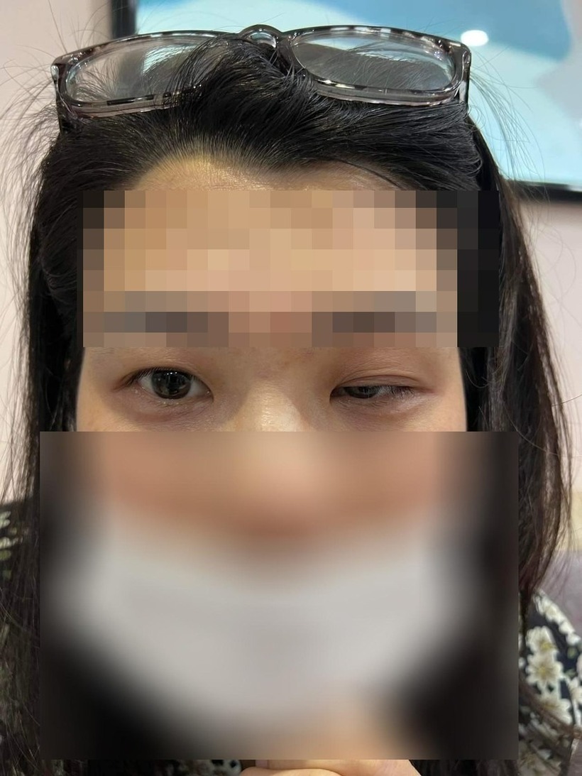Trường hợp liệt mí sau tiêm Botox cải thiện nếp nhăn trán. Ảnh: Pháp luật Việt Nam.
