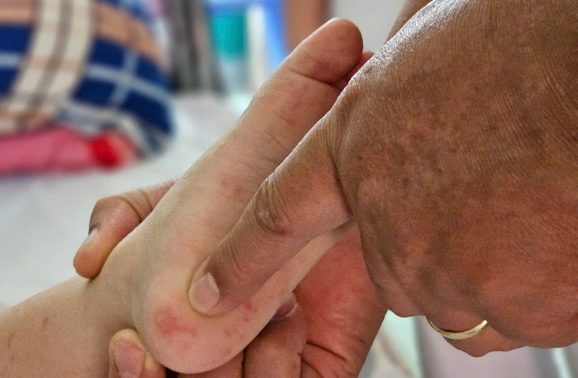 Tay chân miệng đang có xu hướng gia tăng tại Việt Nam, trong đó có khu vực phía Nam. Ảnh minh họa.