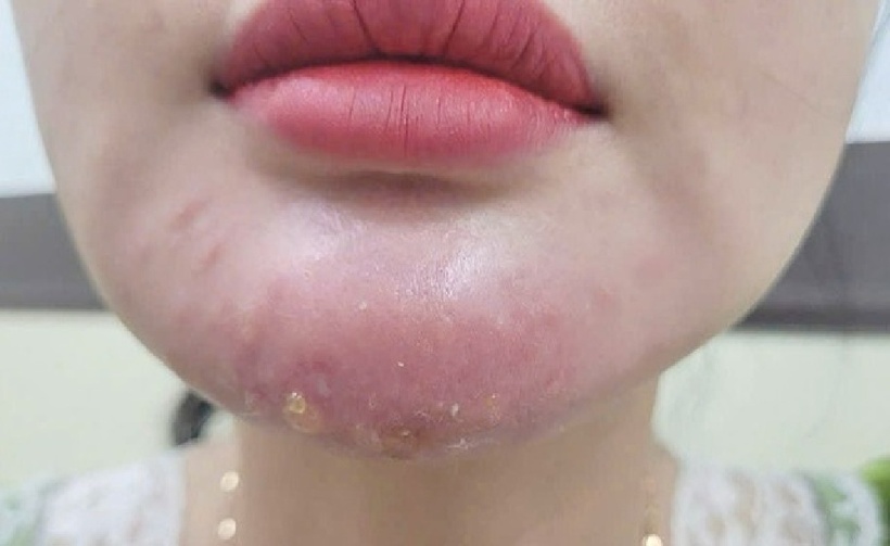Biến chứng nghiêm trọng sau khi tiêm filler. Ảnh: Báo Thanh niên.