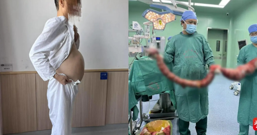 Người đàn ông với cái bụng phình to và khối ruột sau khi được bác sĩ cắt bỏ.