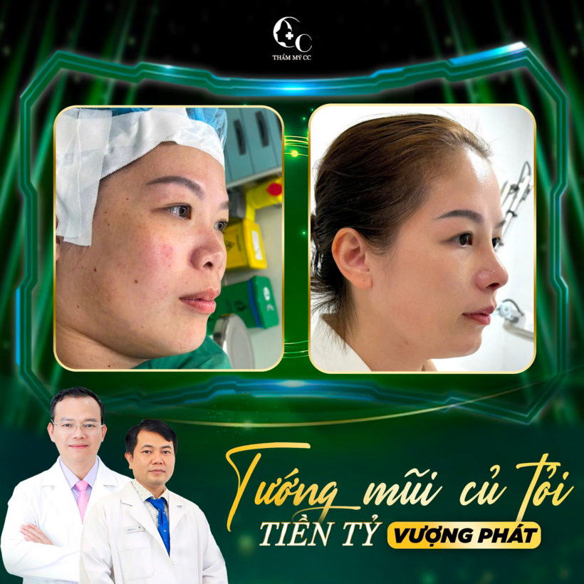 Tướng mũi củ tỏi tại Thẩm mỹ CC