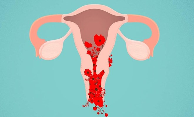 U xơ tử cung dưới niêm mạc có thể gây rong kinh, rối loạn kinh nguyệt