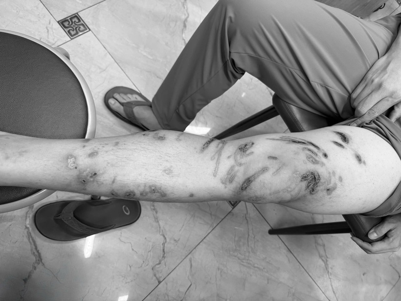 Nam thanh niên bỏng da, sẹo phì đại sau 15 phút tắm biển. Ảnh: BSCC