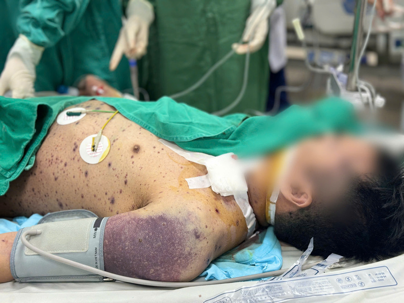 Những nốt thủy đậu tưởng lành tính khiến bệnh nhân khỏe mạnh rơi vào nguy kịch, tiên lượng xấu. Ảnh: BVCC