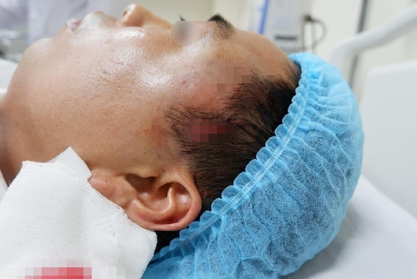 Bên thái dương trái của bệnh nhân có vết khâu 4 cm vùng chân tóc còn rỉ máu. Ảnh: Báo Người lao động.