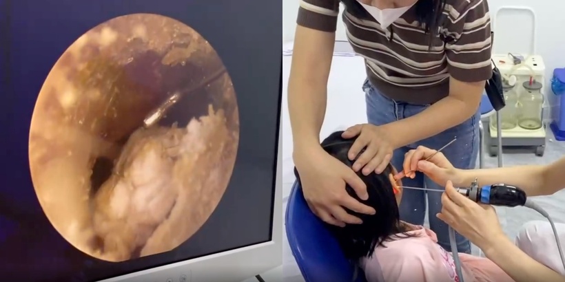 Bé gái 6 tuổi ù tai vì nhét giấy vào tai lúc chơi đùa