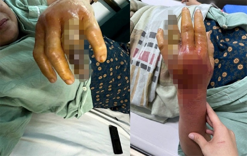 Người phụ nữ bị hoại tử bàn tay sau khi bị gai cá đâm.