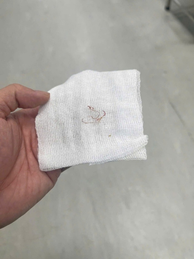 Sợi chỉ được gắp ra từ má bệnh nhân. Ảnh: Sức Khỏe & Đời Sống