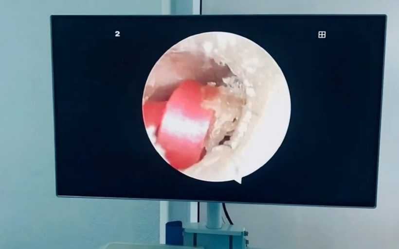 Hình ảnh dị vật bên trong tai bé gái. Ảnh: Thời báo VTV