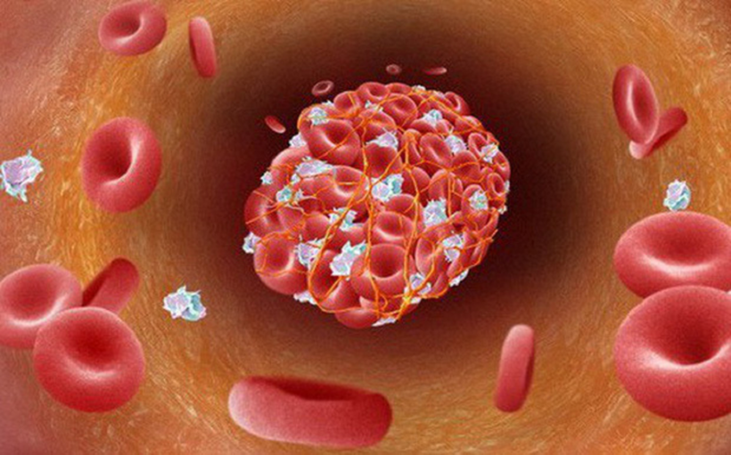 Cục máu đông là huyết khối gây thiếu máu cục bộ tại các cơ quan, có thể đe dọa đến sức khỏe của người mắc