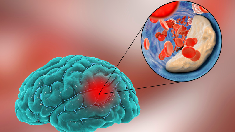 Cục máu đông là nguyên nhân chính dẫn đến tai biến mạch máu não do tắc mạch