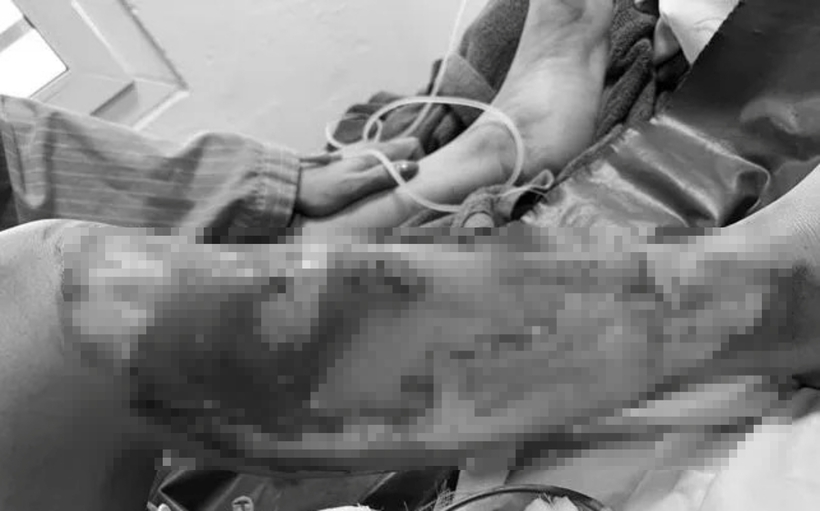 Bệnh nhân nhập viện với vết bỏng độ 2 vùng cánh tay và cẳng chân phải, bọng nước và đau rát nhiều. Ảnh: Thời báo VTV