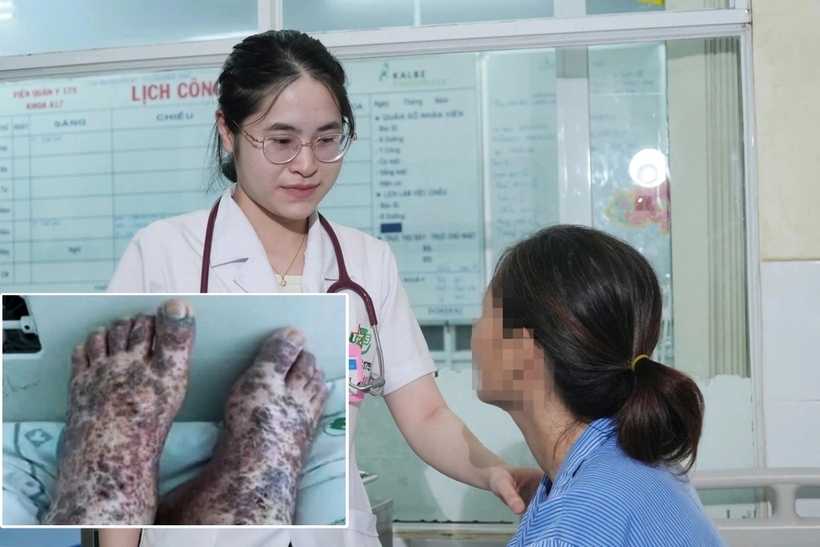 Bệnh nhân xuất huyết toàn thân vì hội chứng Evans. Ảnh: Dân trí