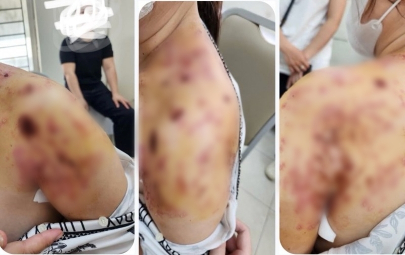 Sau thời gian bó lá, người phụ nữ bị nhiễm trùng, lở loét mưng mủ nặng quanh vùng bả vai và cánh tay. Ảnh: Công An Nhân Dân