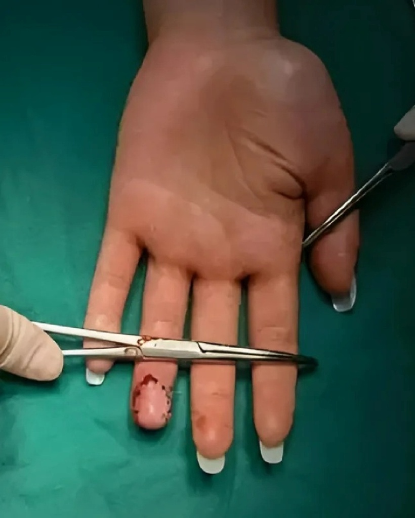 Các bác sĩ đã tiến hành phẫu thuật nối ngón tay cho bệnh nhân. Ảnh: Weibo.