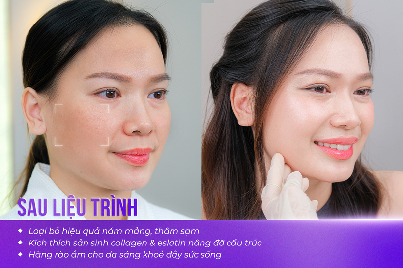 Sau liệu trình, làn da có sự thay đổi rõ rệt.