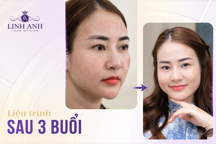 Khách hàng hài lòng sau khi điều trị bằng công nghệ cấy PRP.