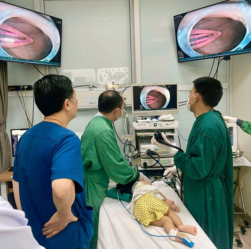Các bác sĩ tiến hành gắp dị vật ra khỏi dạ dày của bé gái 21 tháng tuổi. Ảnh: BVCC