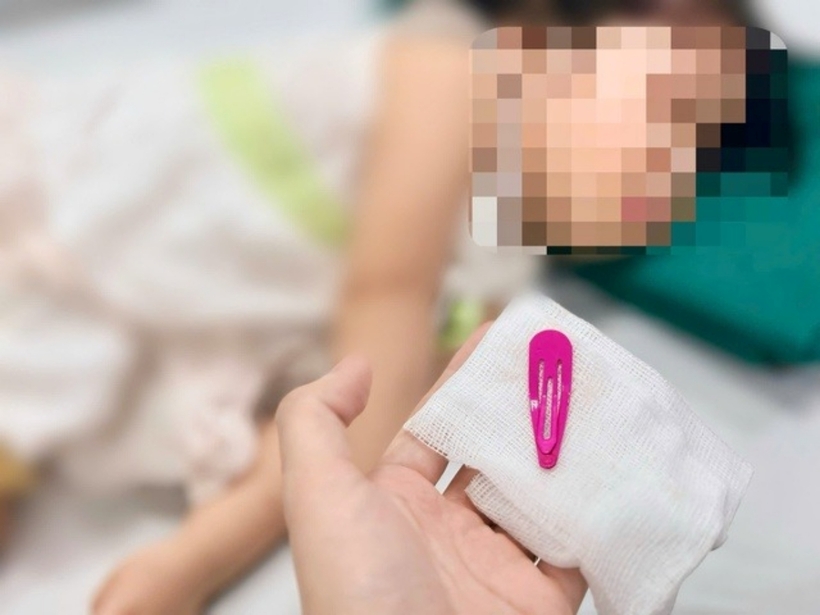 Chiếc kẹp tóc được lấy ra ngoài. Ảnh: Sức Khỏe & Đời Sống