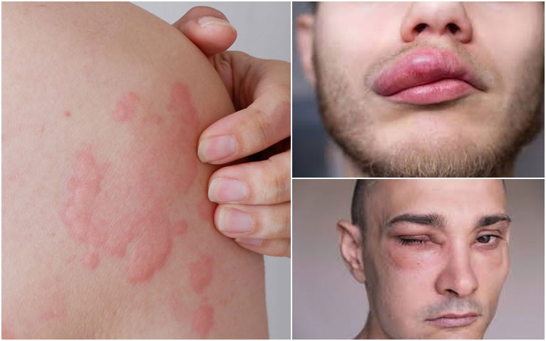 Mề đay bùng phát do ô nhiễm môi trường.