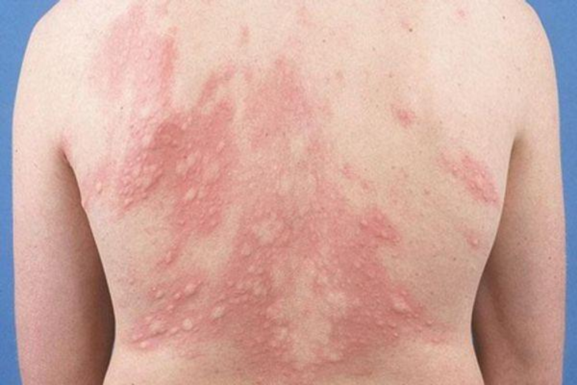 Ô nhiễm môi trường là tác nhân âm thầm gây ra mề đay mạn tính