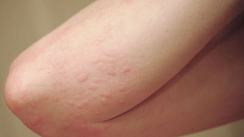 Cao Nhàu từ lâu đã xuất hiện trong các bài thuốc dân gian hỗ trợ cải thiện mề đay
