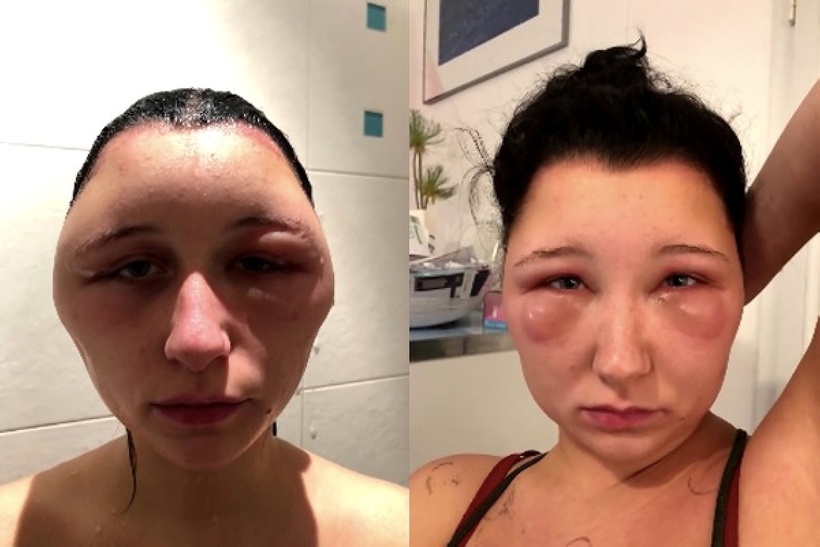 Đầu cô gái sưng to gần gấp đôi, trông như một quả dưa hấu. Ảnh: Health.