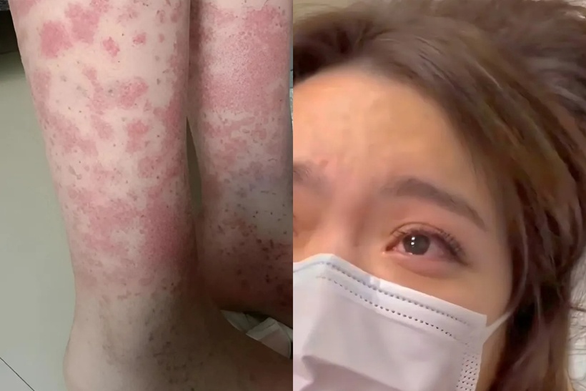 Các bác sĩ chẩn đoán Tiểu Lâm mắc "viêm thận do ban xuất huyết". Ảnh: Hoa học trò.