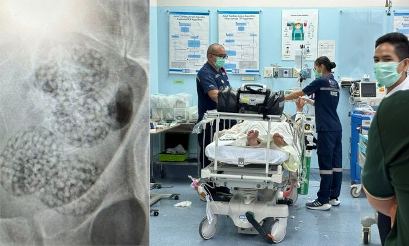 Một vài vật thể tròn bên trong ruột của bệnh nhân. Ảnh: Khaosod.