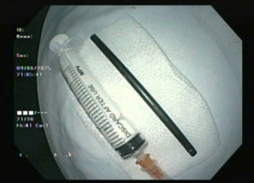 Ekip nội soi gắp thành công một dị vật dạng ống nhựa dài 12cm từ đoạn tá tràng của bệnh nhi. Ảnh: Sức Khỏe & Đời Sống