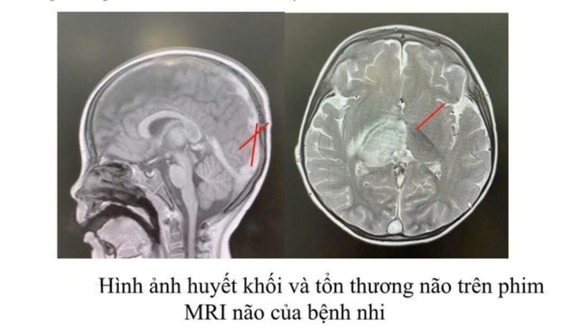 Hình ảnh huyết khối và tổn thương não trên phim MRI não. Ảnh: Sức Khỏe & Đời Sống