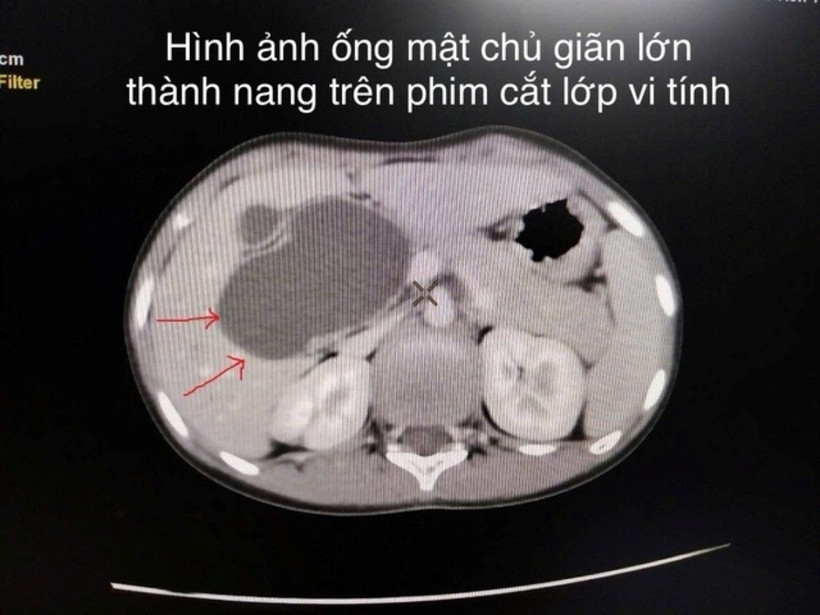 Phim cắt lớp vi tính cho thấy hình ảnh ống mật chủ giãn lớn thành nang. Ảnh: Sức Khỏe & Đời Sống
